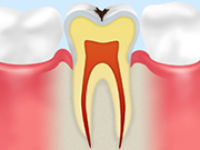 ［画像］C1：エナメル質の虫歯