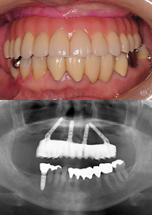 all on 4③治療後