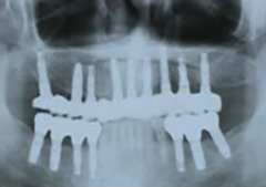 小さなころから歯医者に通う習慣をつけましょう