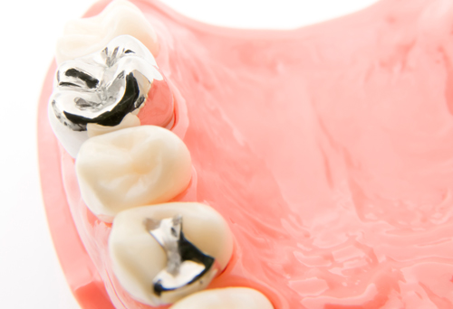 銀歯のない美しい口もとに