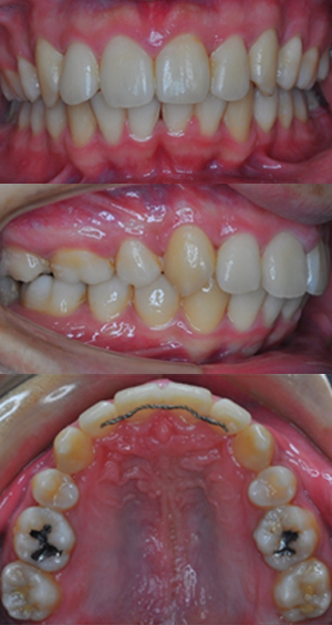上顎前突治療後
