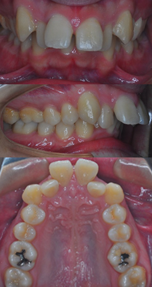 上顎前突治療前