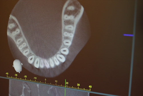 歯を失う原因の多くは歯周病が原因です