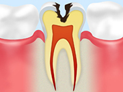 ［画像］C2：象牙質の虫歯