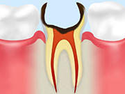 ［画像］C4：歯根に達した虫歯
