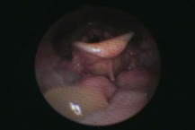 VE（嚥下内視鏡）の画像04