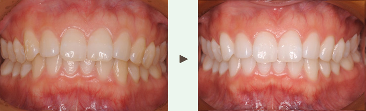 ホームホワイトニング症例