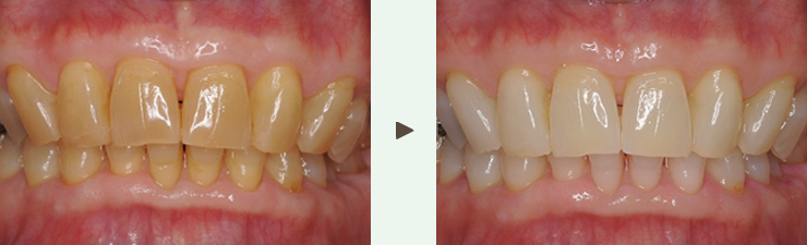 デュアルホワイトニング症例