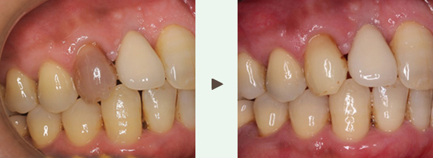 ウォーキングブリーチ症例